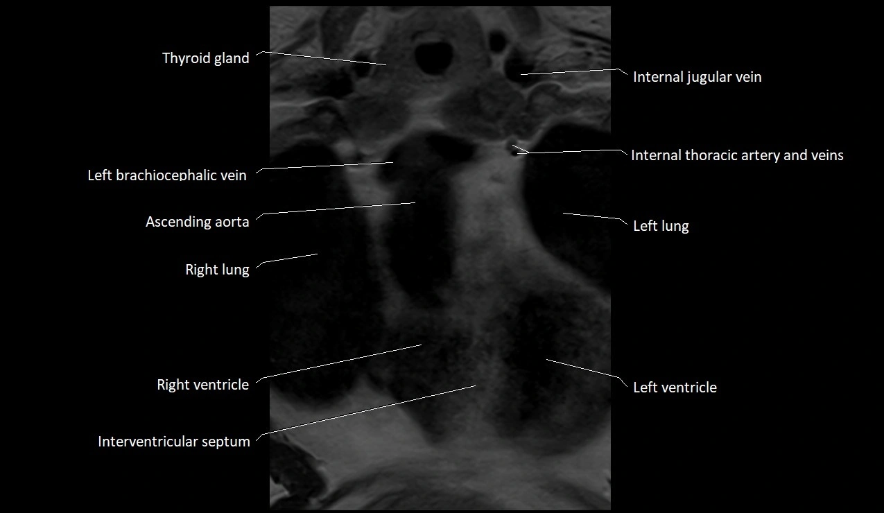 MRI sternum and sternoclavicular joint labeled coronal anatomy image 18.webp